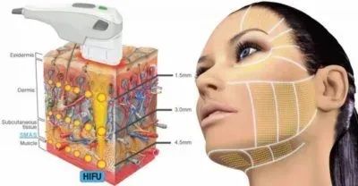 HIFU treatment diagram for skin layers and face.