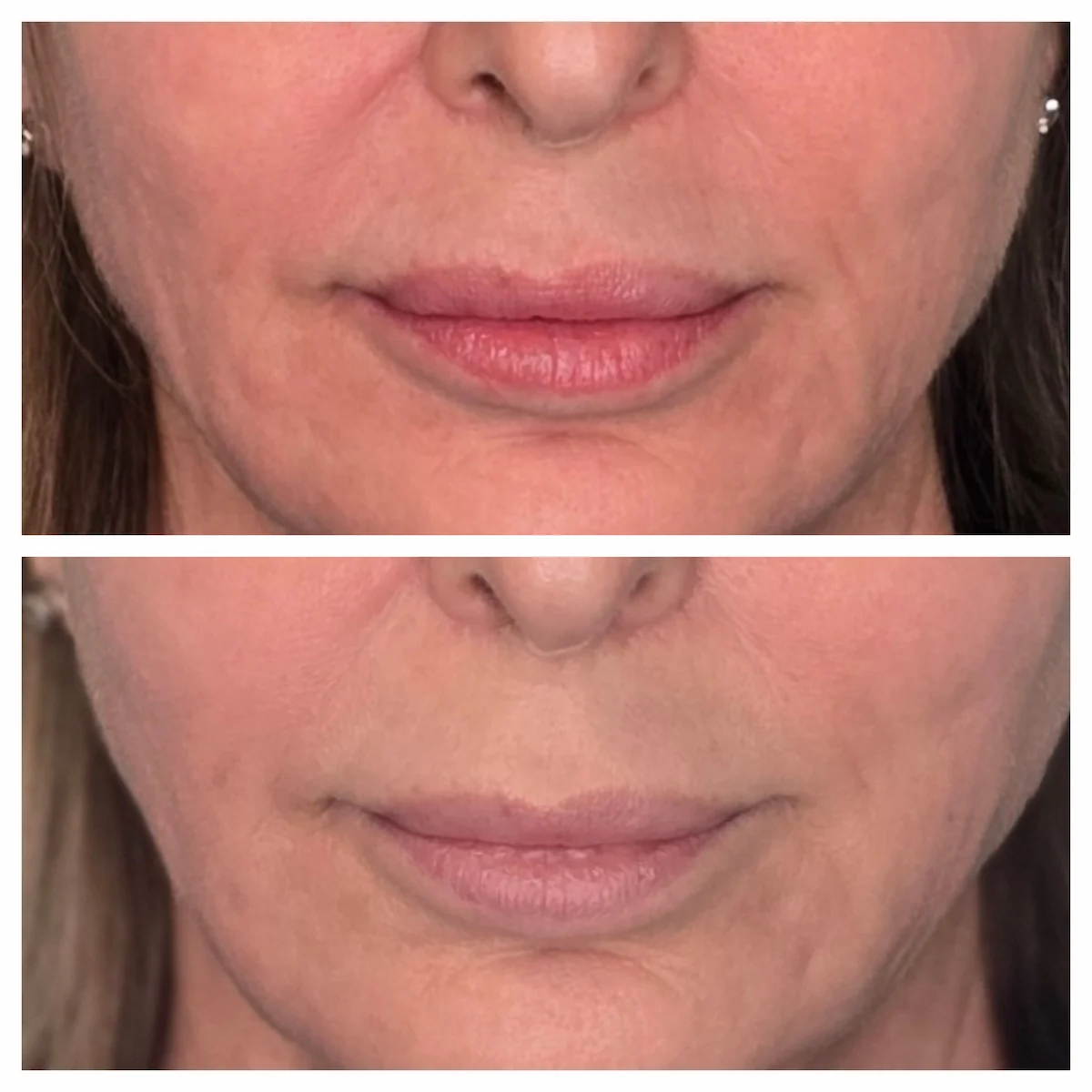 tampa hydrafacial patient model receiving treatment
