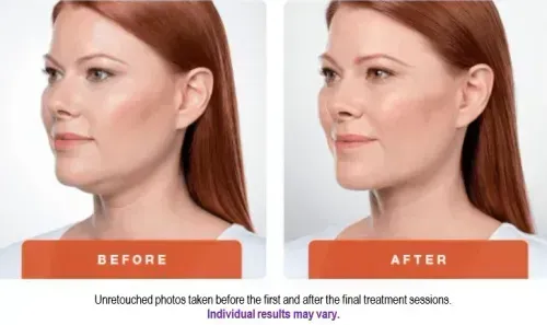 before and after Kybella double-chin treatment