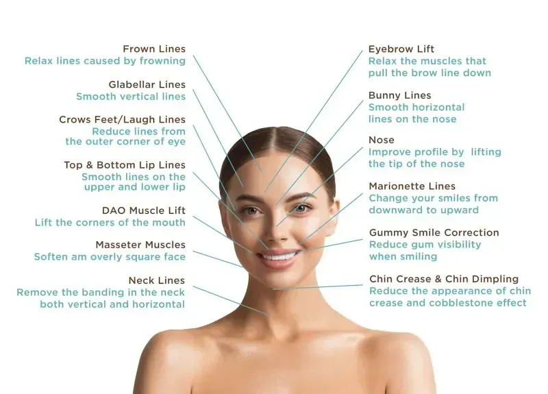 Diagram of facial injection points for Botox and dermal fillers