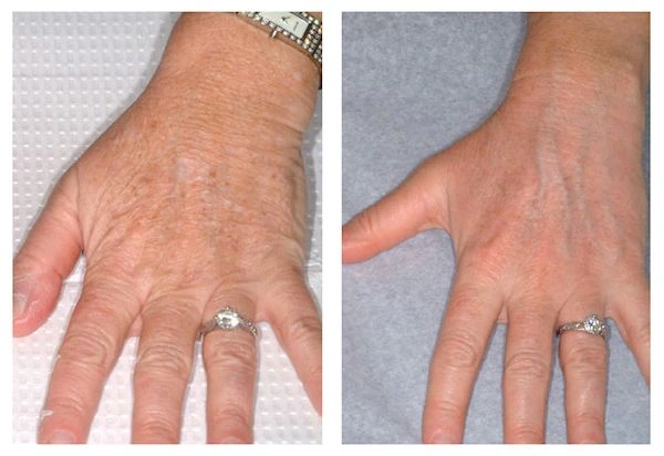 hand rejuvenation before and after cosmetic filler