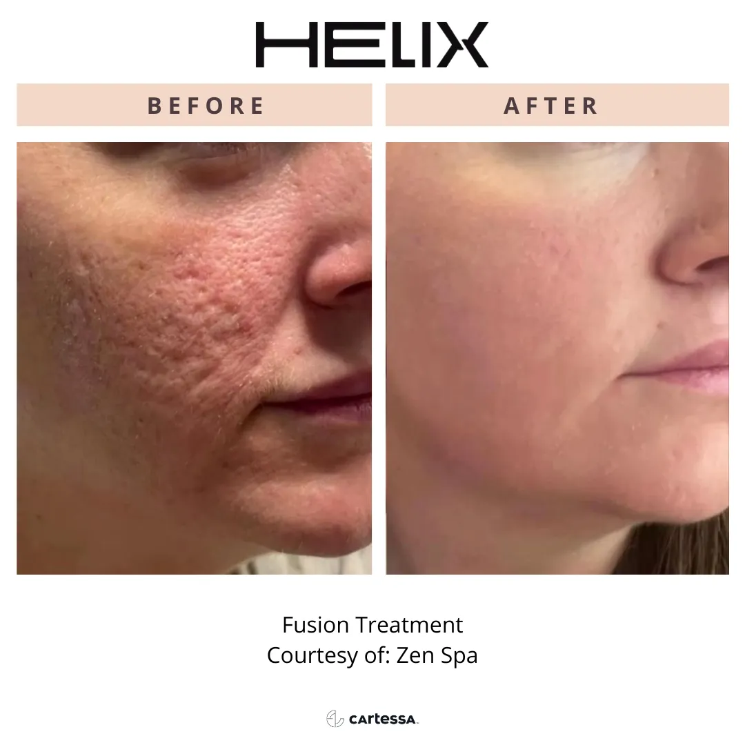 Helix Before and after