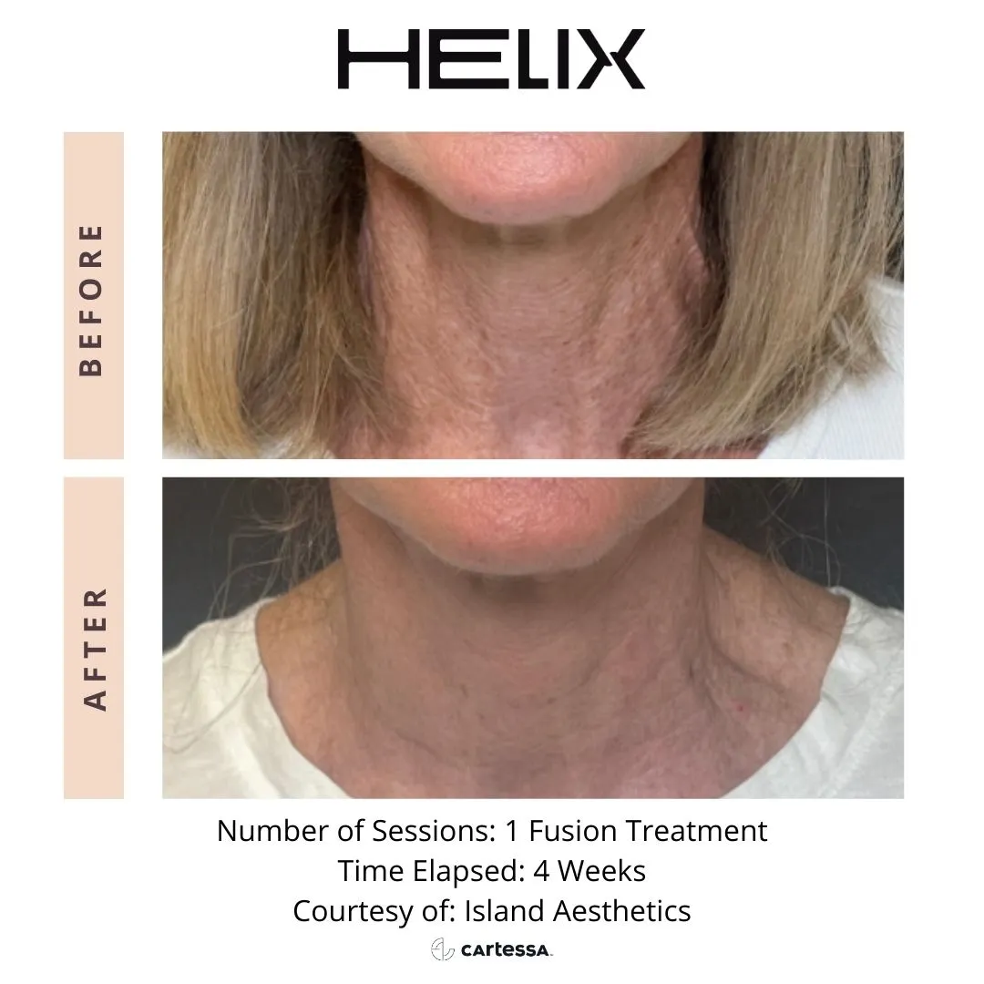 Helix Before and after