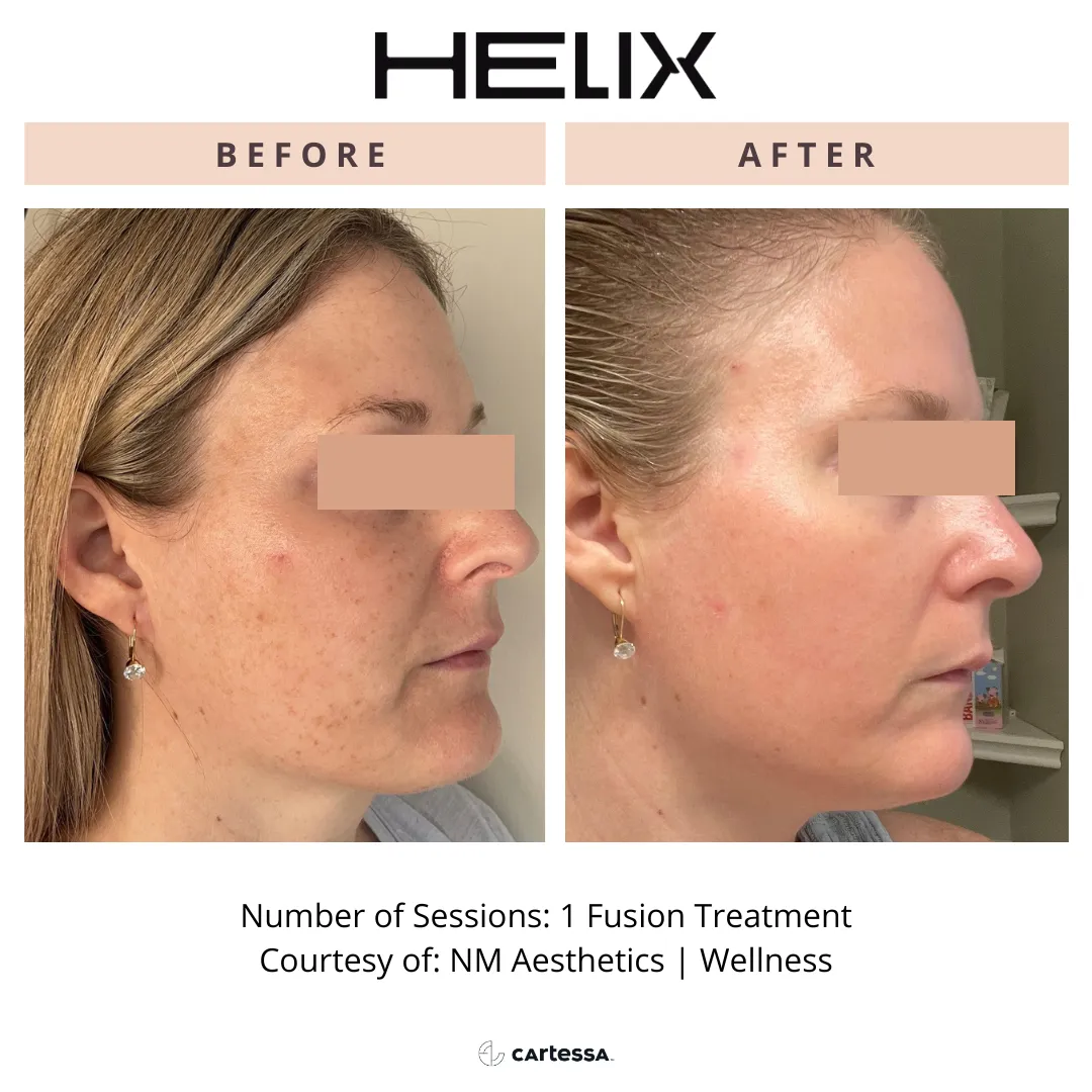 Helix Before and after
