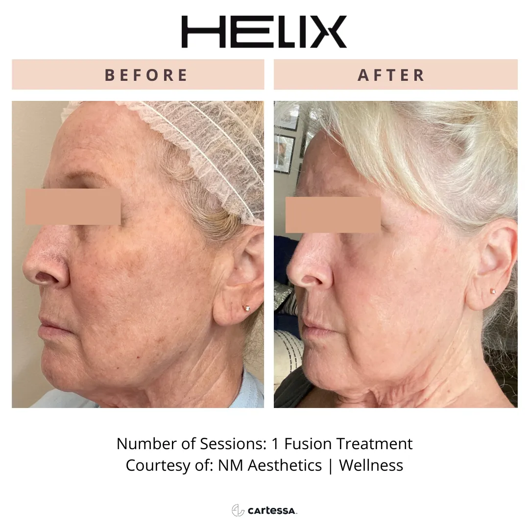 Helix Before and after