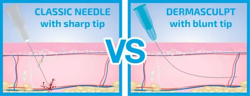 illustration of classic needle with sharp tip VS. Dermasculpt with blunt tip being injected into the skin