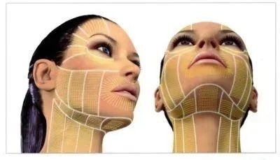 ultherapy treatment area diagram