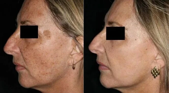 laser skin resurfacing before and after at Vein & Cosmetic Center Tampa Bay