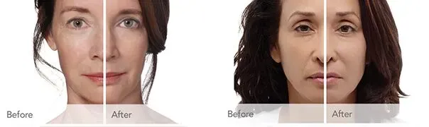 Radiesse before and after