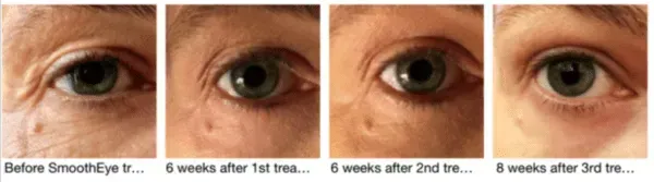 Smooth Eyes treatment before and 8 weeks after
