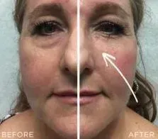 woman with arrow pointing to under eye after tear trough filler treatment