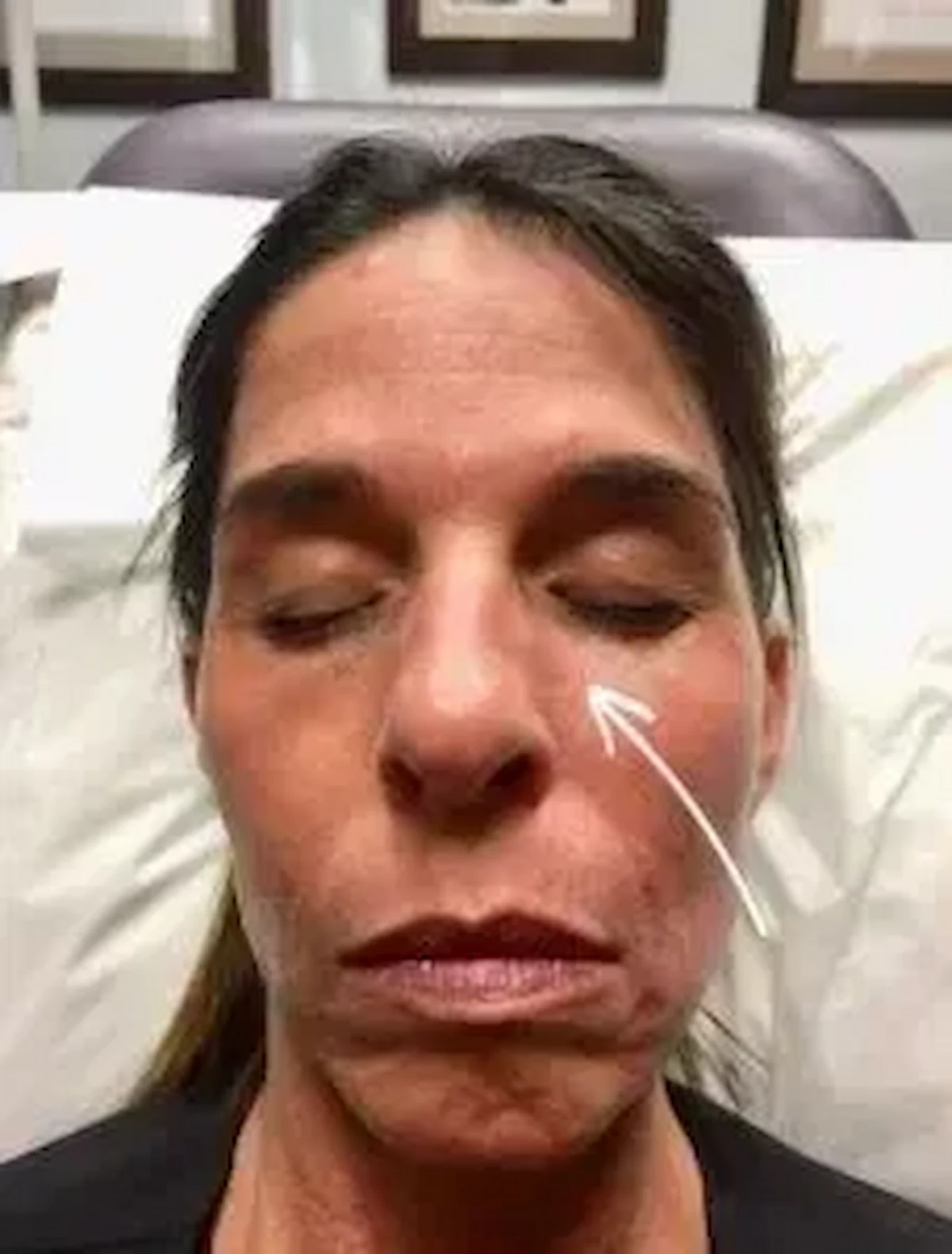 woman with arrow pointing to under eye after tear trough filler treatment