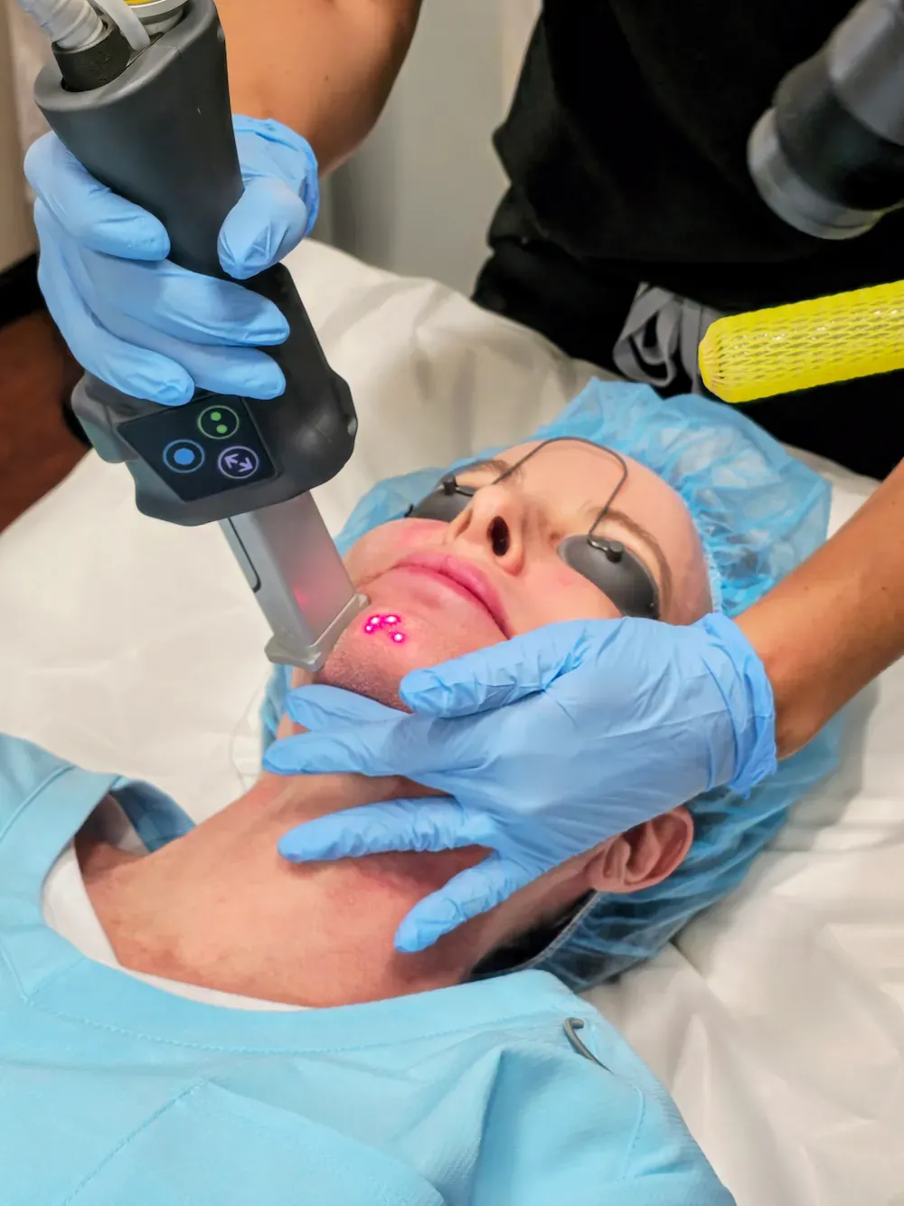HELIX CO2 fractional laser device used for advanced skin resurfacing
