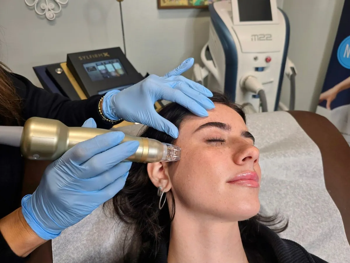 Sylfirm X pulsed wave RF microneedling device for vascular and pigment correction