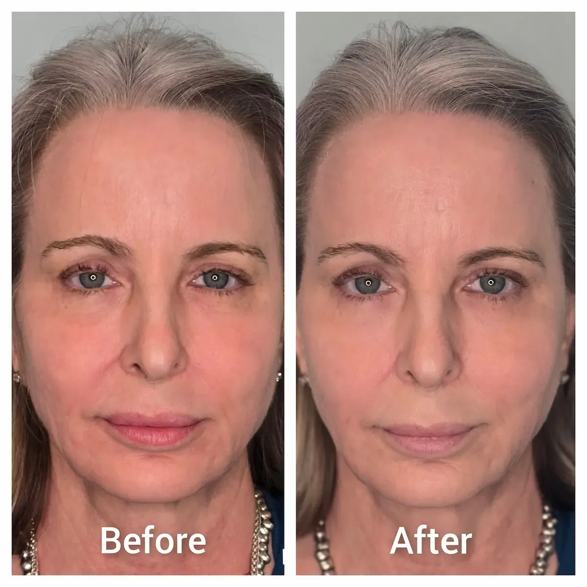 Woman's skin before and after PRX Derm Perfexion treatment