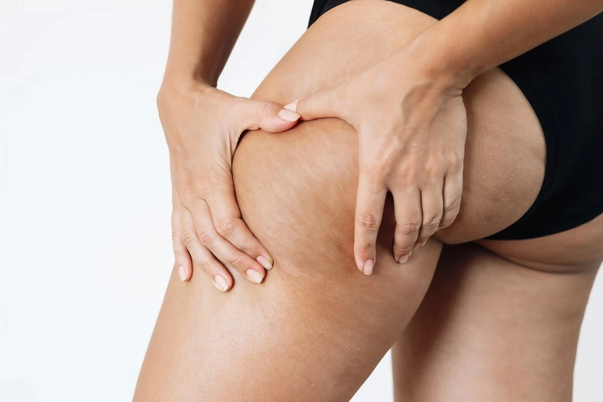woman touching cellulite on thighs