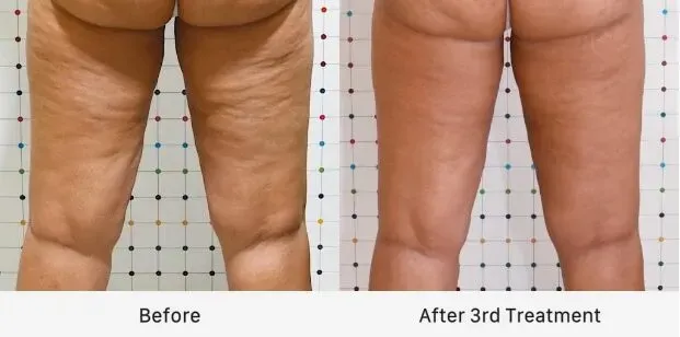 before and after 3rd sculpt treatment on back legs