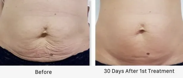 before and 30 days after sculpt treatment on belly fat