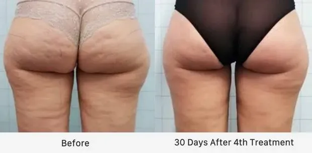 before and after sculpt with improved cellulite 30 days after 4th treatment on back legs