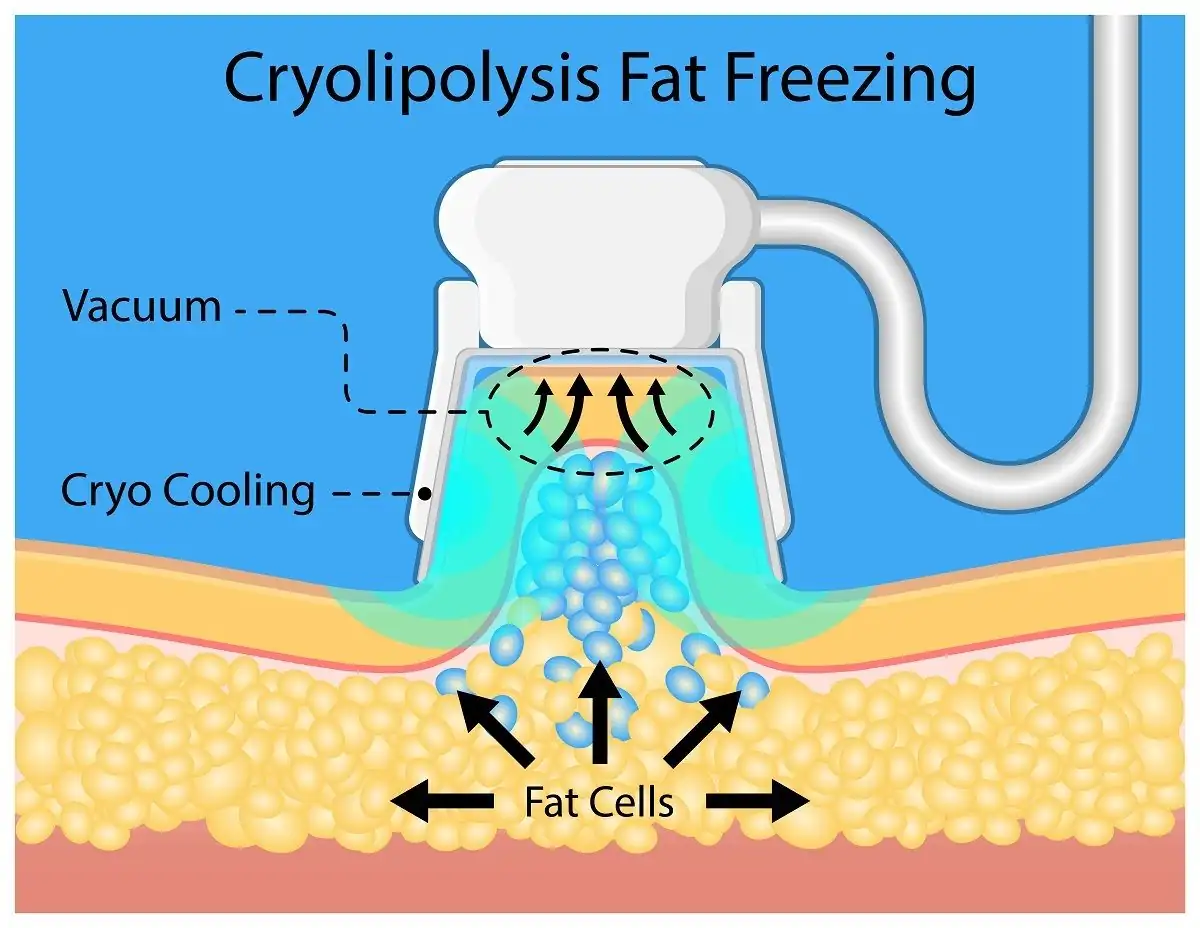 Diagram explaining the cryolipolysis fat-freezing process used by CoolSculpting Elite