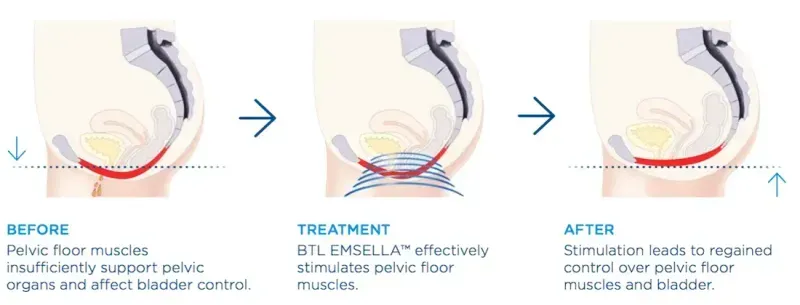how emsella works graphic