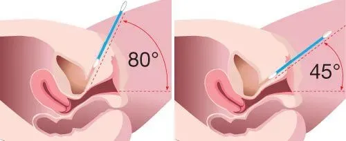 incontilase illustration