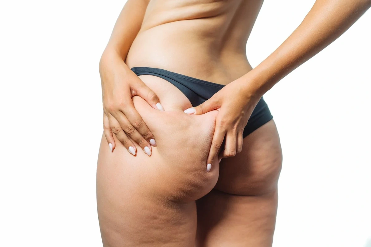 woman touching cellulite on buttocks