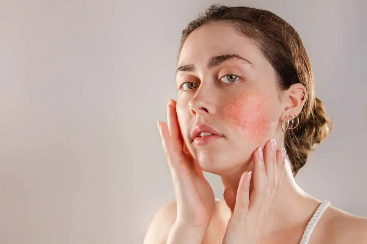 woman with rosacea skin disorder