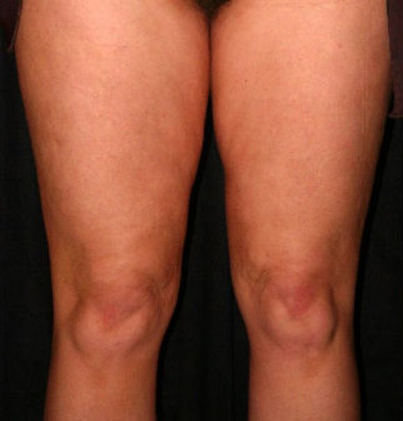 Patient 1 after photo