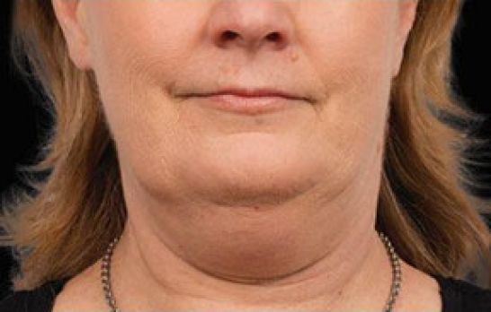 Patient 1 before photo