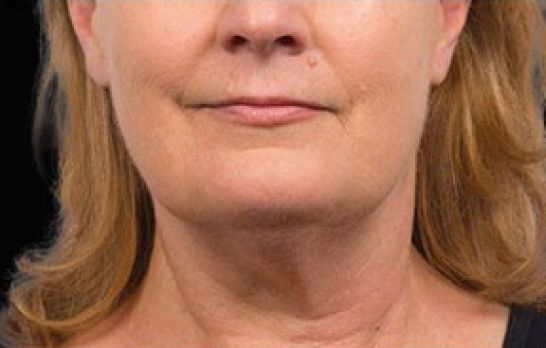 Patient 1 after photo