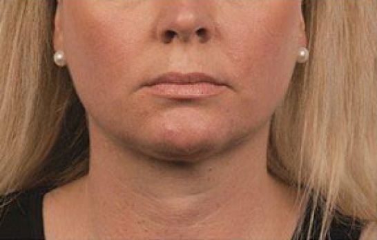 Patient 3 after photo