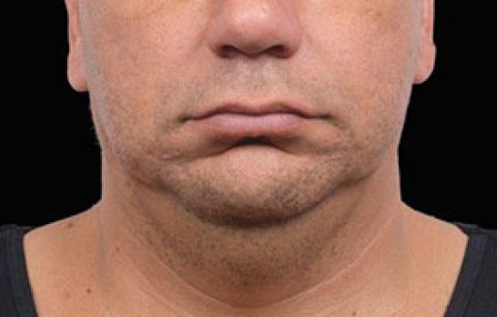 Patient 5 after photo
