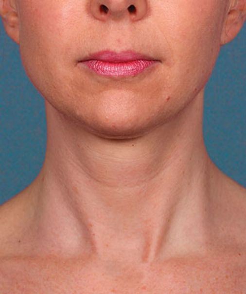 Patient 1 before photo