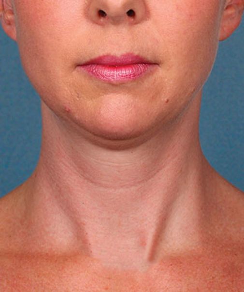Patient 1 after photo