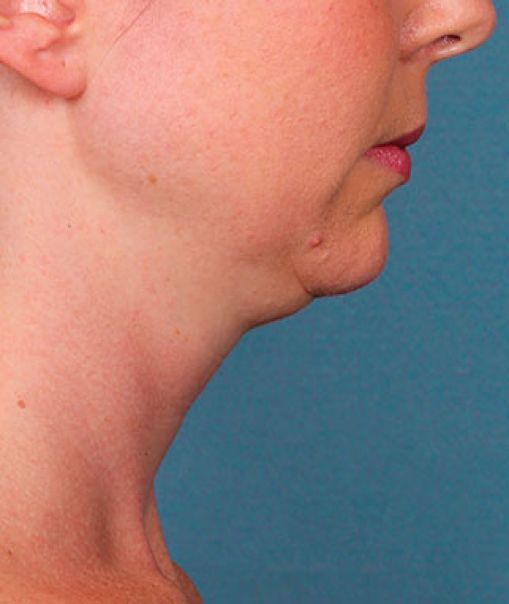 Patient 2 before photo