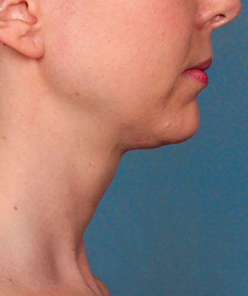 Patient 2 after photo