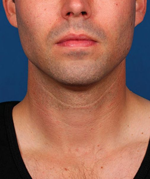 Patient 3 after photo
