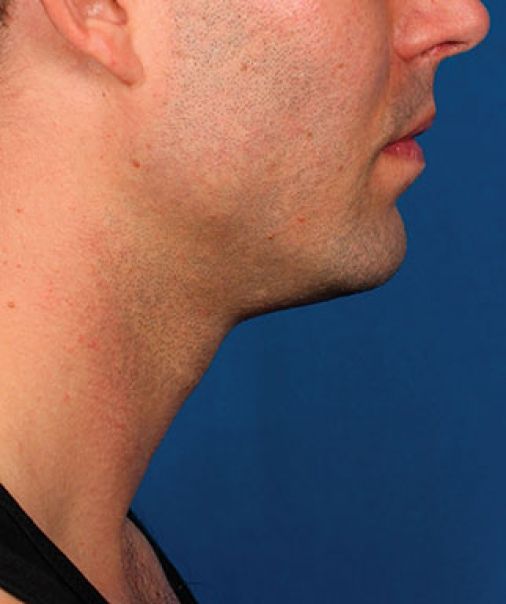 Patient 4 after photo