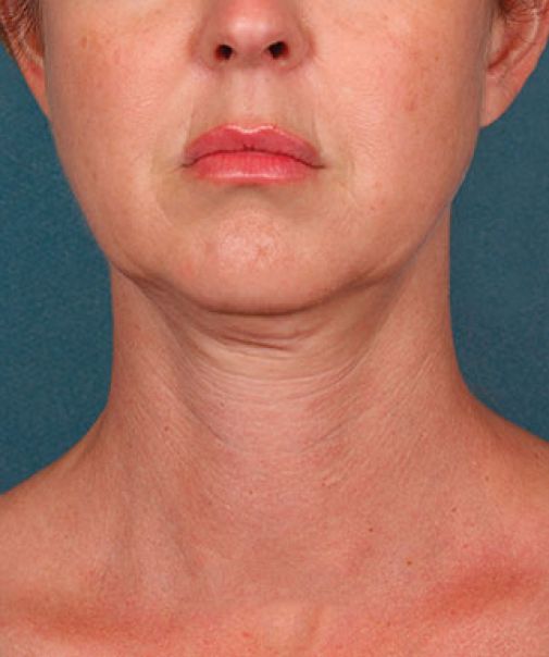 Patient 5 before photo