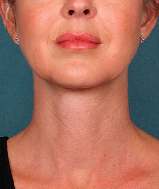 Patient 5 after photo