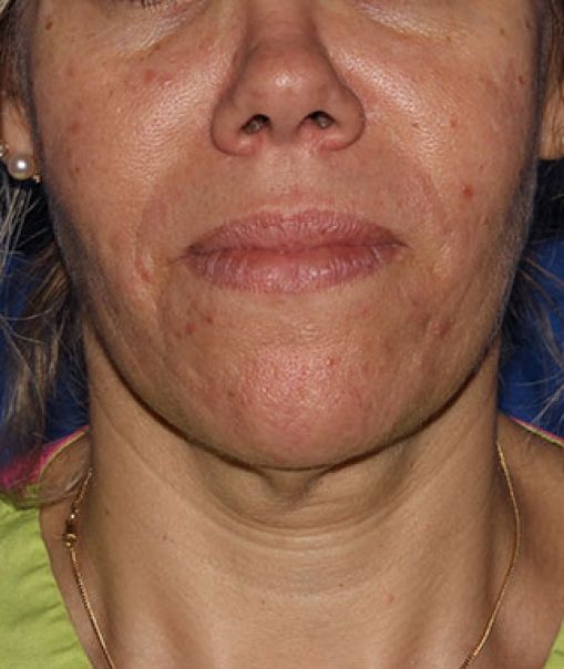 Patient 7 after photo