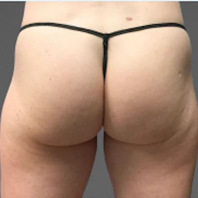 Patient 1 after photo