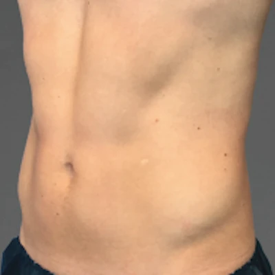 Patient 4 after photo