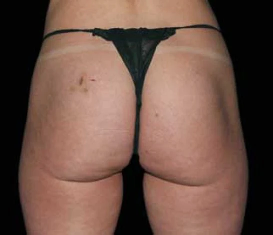 Patient 5 after photo