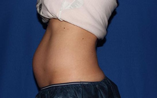 Case-1185 before