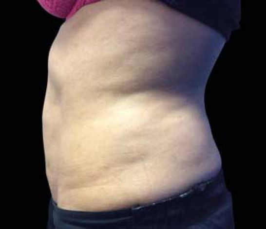 Patient 2 after photo