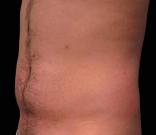 Patient 5 after photo