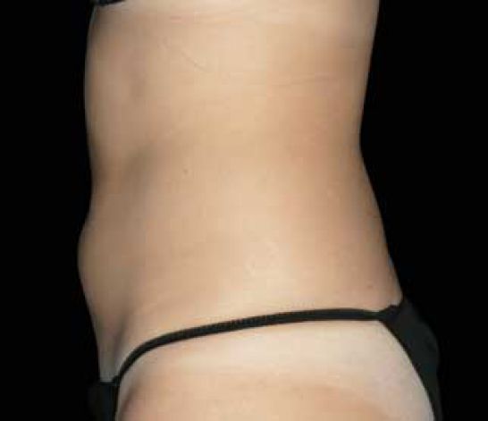 Patient 7 after photo