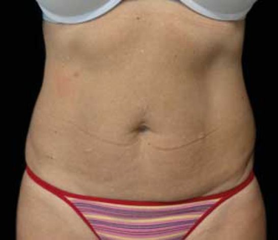 Patient 8 after photo